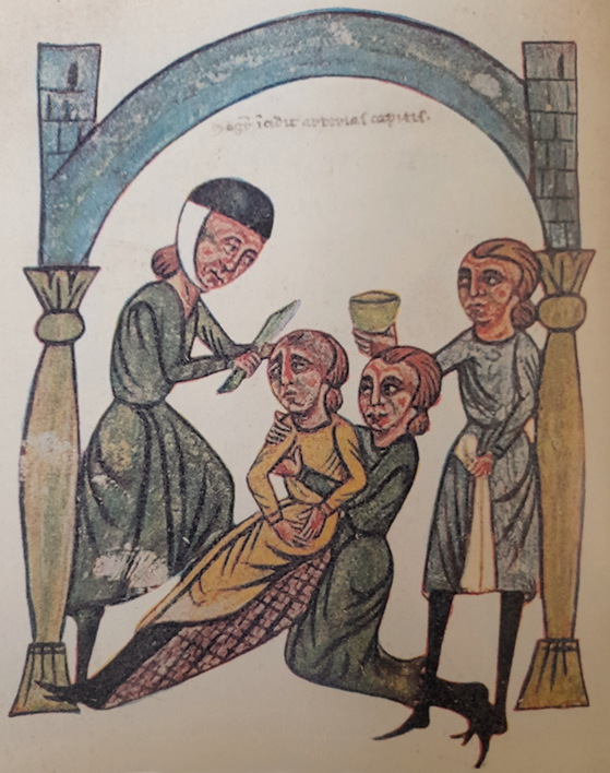 Intervento chirurgico con incisioni per salasso da tempie e fronte, illustrazione della Rolandina, trattato di chirurgia di Rolando da Parma, detto Rolando de Cappelluti, XIII sec., Biblioteca Casanatense di Roma, codice latino 1382